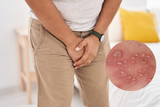 bao quy đầu bị sưng mọng nước