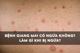Bệnh giang mai có ngứa không? Làm gì khi bị ngứa?