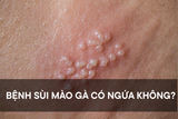 Bệnh sùi mào gà có ngứa không - Cách giảm ngứa và phòng tránh hiệu quả