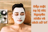 đắp mặt nạ bị rát