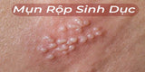 mụn rộp sinh dục nam giới
