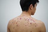 6 Nguyên Nhân Gây Mụn Ở Lưng Nam Giới Và Cách Khắc Phục Triệt Để
