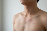 Nổi mụn ở ngực nam giới: Nguyên nhân, cách xử lý và bí quyết chăm sóc da