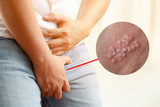 nam giới bị sùi mào gà có bị vô sinh không