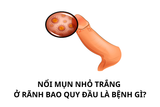 nổi mụn nhỏ trắng ở rãnh bao quy đầu