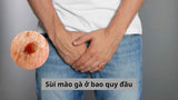 Sùi mào gà ở bao quy đầu là bệnh gì? Có nguy hiểm không?