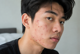 Rối loạn nội tiết tố nam gây mụn: Nguyên nhân và cách phòng tránh